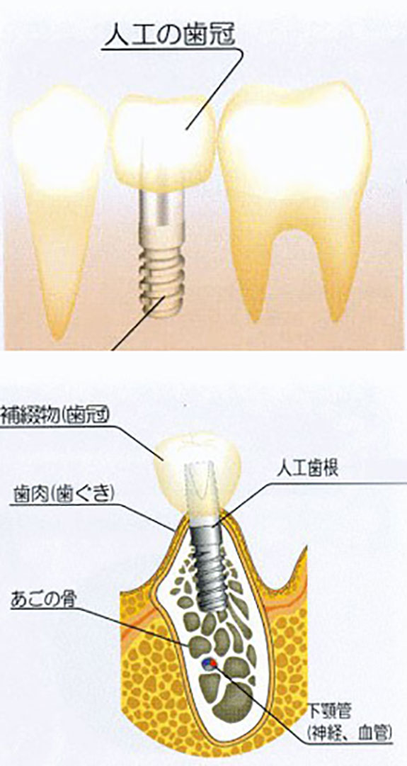 インプラントと天然歯の違い