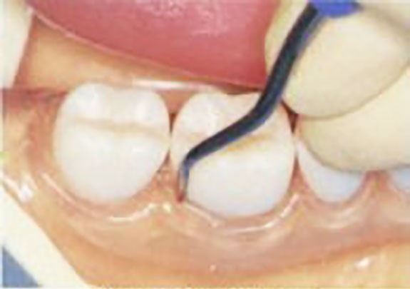 臼歯の歯石除去