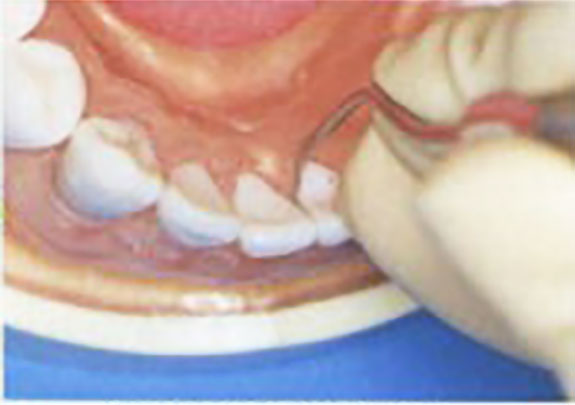 前歯の歯石除去