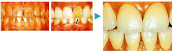 【 くすみ歯と破片の症例 】
