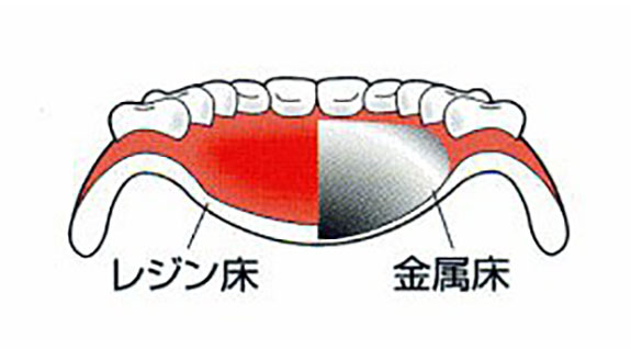 金属床義歯（入れ歯）の特徴